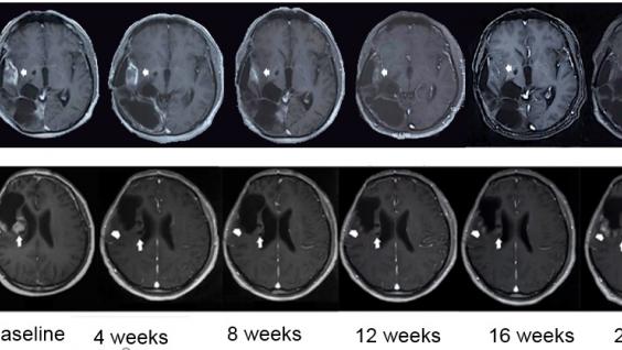 Two patients experienced significant tumor shrinkage lasting for more than 12 weeks in the clinical trial.